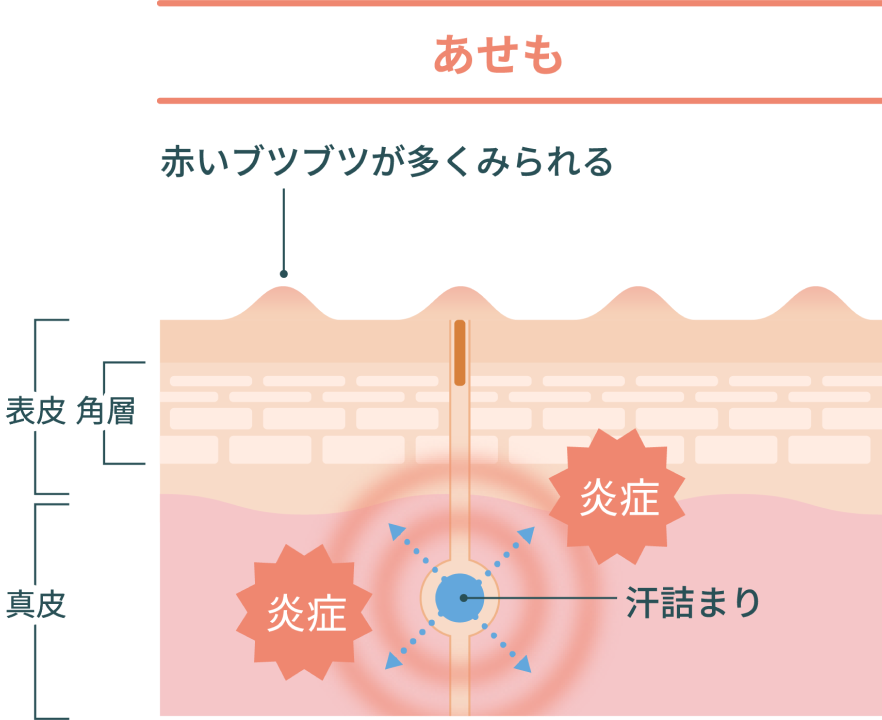 あせもの原因 対処法 薬局 薬店で相談できる皮膚トラブル ヒフシルワカル あせもの原因 対処法 薬局 薬店で相談できる皮膚トラブル ヒフシルワカル