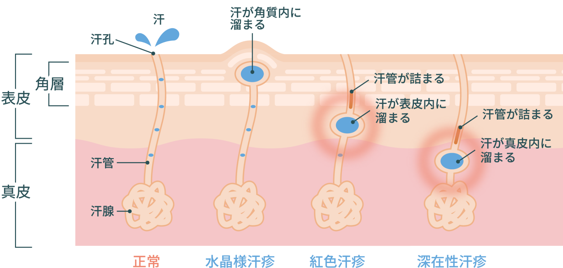 あせもの原因 対処法 薬局 薬店で相談できる皮膚トラブル ヒフシルワカル