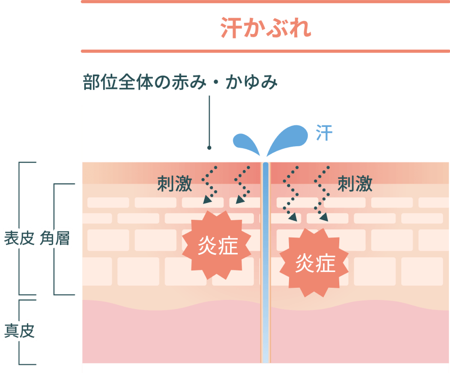 汗かぶれ