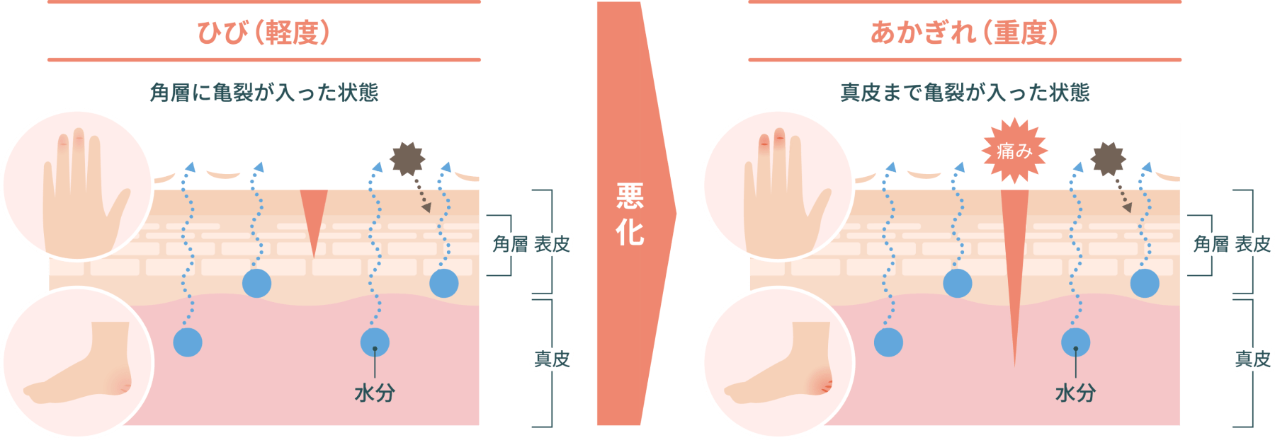 あかぎれの原因