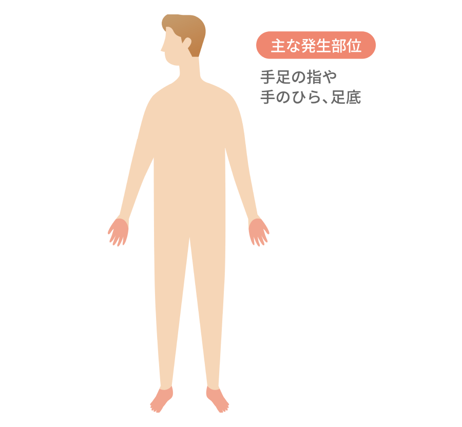 異汗性湿疹の主な発生部位