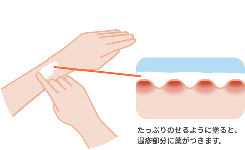 たっぷりのせるように塗ると、
湿疹部分に薬がつきます。