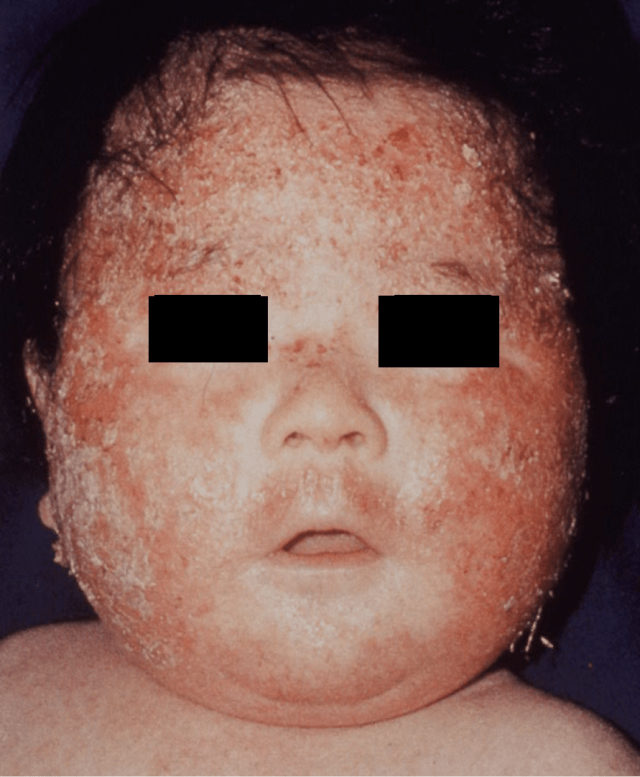 乳児脂漏性湿疹（皮膚炎）