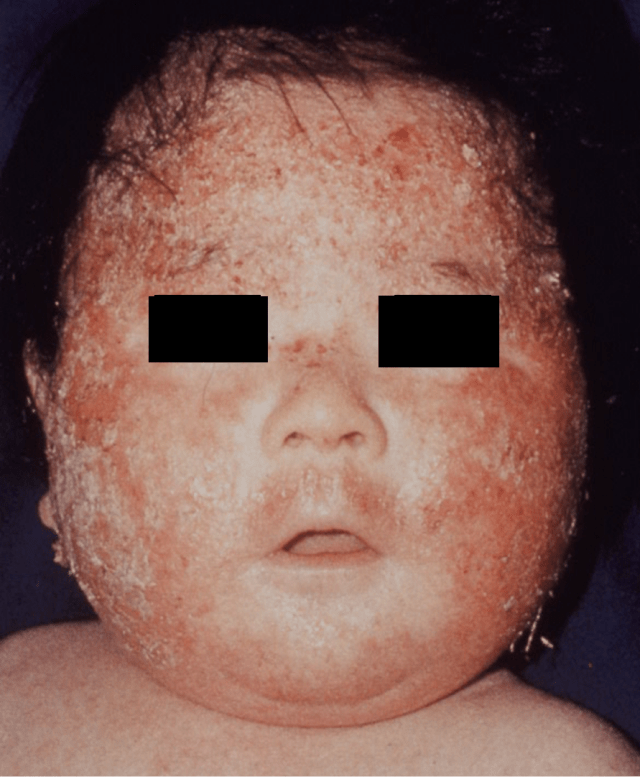 乳児脂漏性湿疹(皮膚炎)