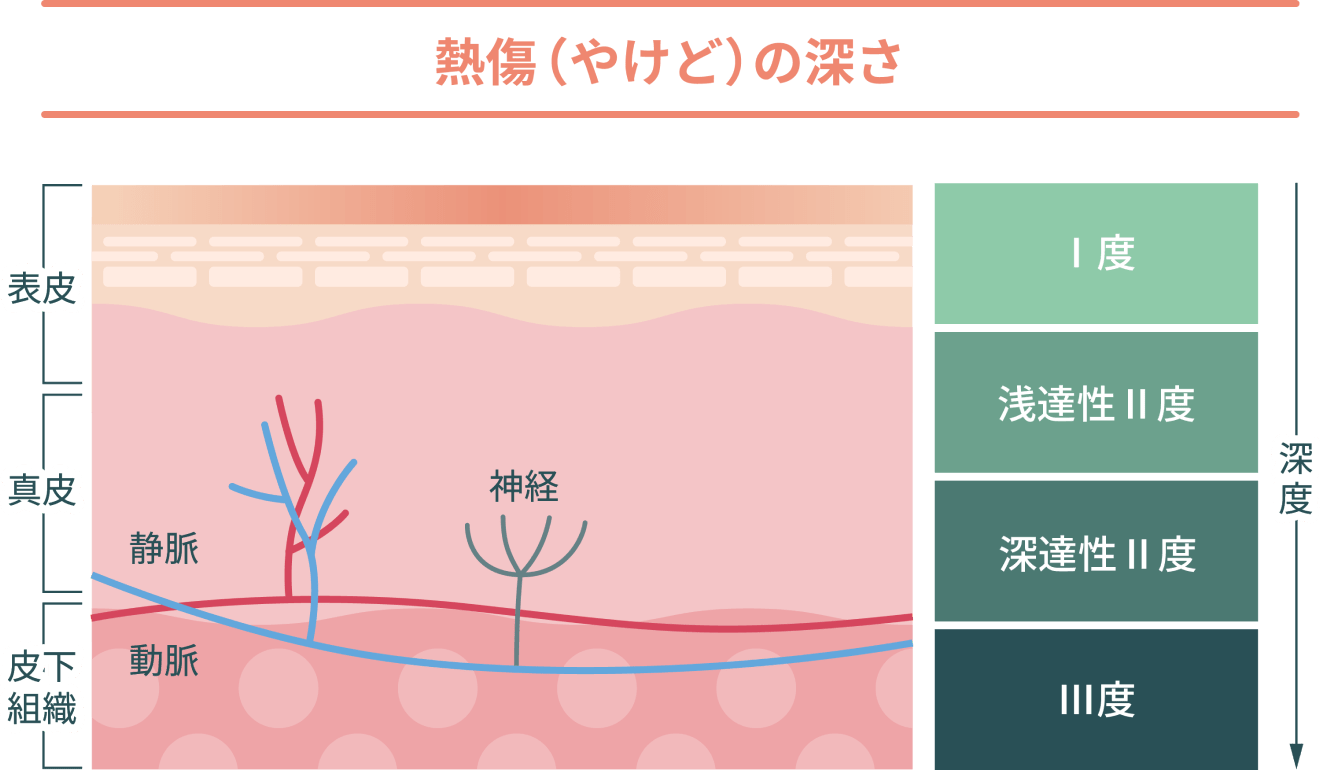 熱傷（やけど）の深さ