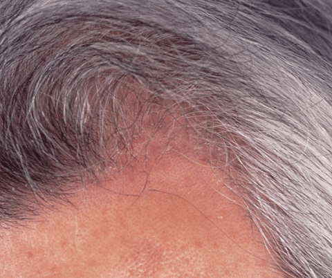 頭皮湿疹
