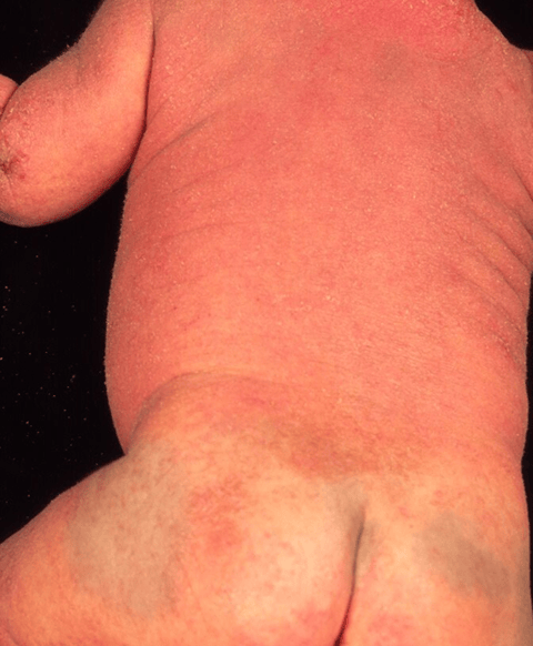 乳児アトピー性皮膚炎