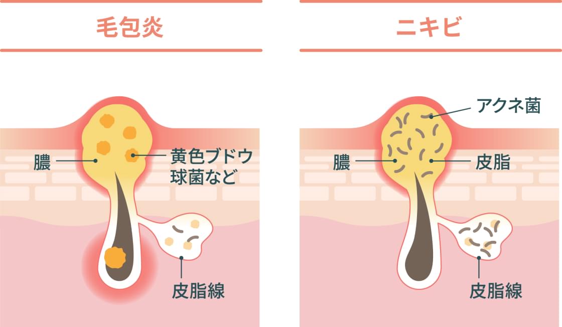 毛のう炎とニキビの比較