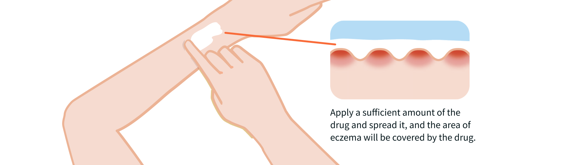 Topical steroids should be applied gently.